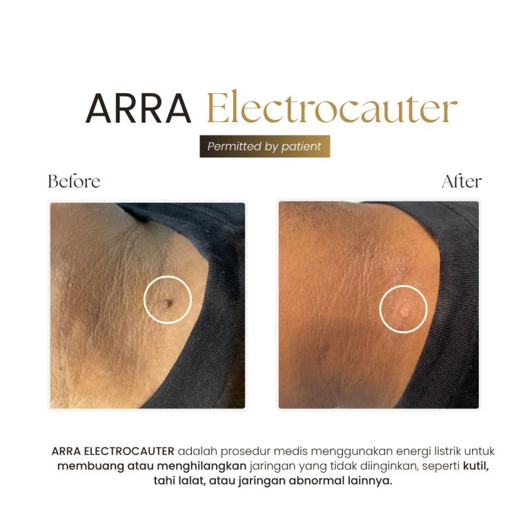 Electrocauter